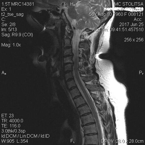 Osteochondrosis a spondylóza krční páteře