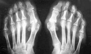 Diferenciální diagnostika symptomů artritidy a artrózy