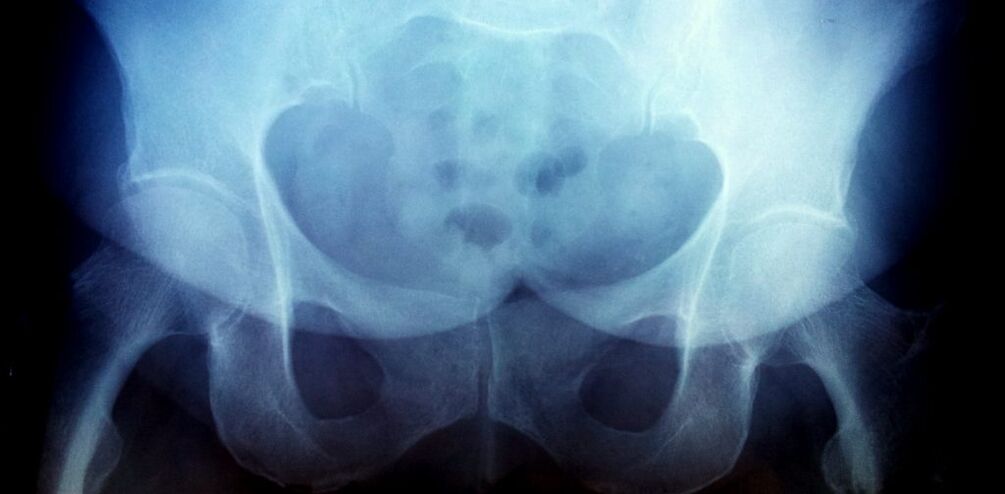 X -ray obrázek s artrózou 2. stupně